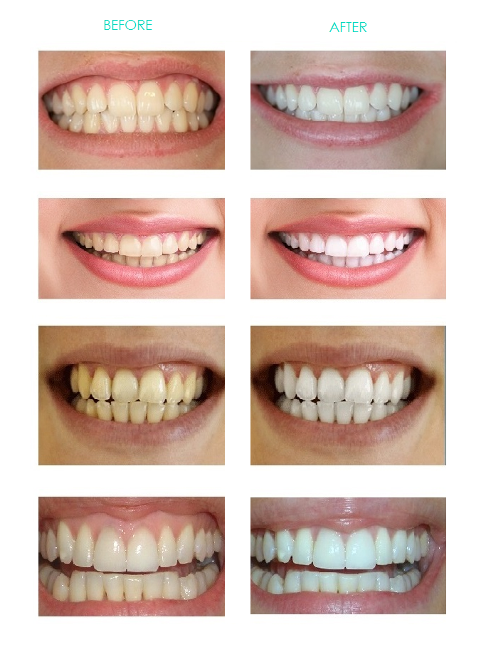 Strongest PRO- Teeth Whitening KIT & WhiteStrips LUXE System + Bonus dentist whitening booster set
